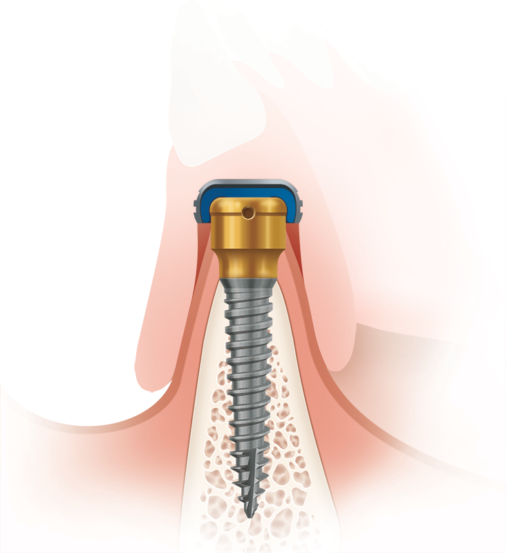 Schaubild LODI - LOCATOR® Overdenture Implant System im Einsatz